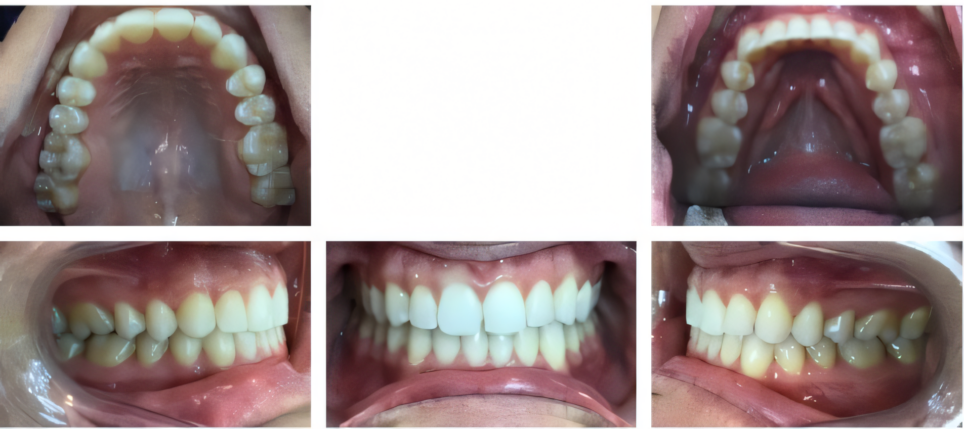 Invisalign for adults after